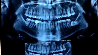 پیوند استخوان و ایمپلنت تاخیری