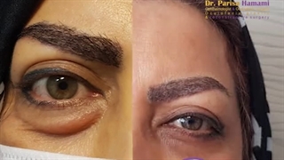قبل و بعد عمل بلفاروپلاستی پلک پایین در بیمار تیروئید با بیرون زدگی چشم راست