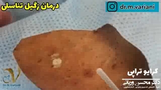 بهترین درمان برای زگیل تناسلی