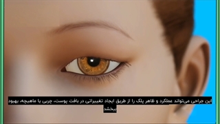 هزینه جراحی پلک چقدر است؟ کلینیک مو