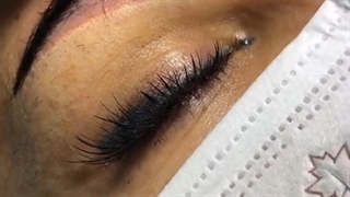 کاشت مو و ابرو همزمان