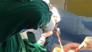 تعویض مفصل دو طرفه زانو