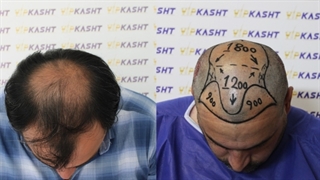 کلینیک کاشت مو vip بهترین کلینیک کاشت مو