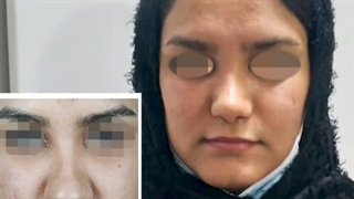 جراحی زیبایی بینی