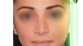 جراحی زیبایی بینی