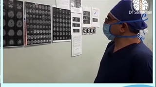 عمل جراحی تشنج مقاوم به درمان ;ضایعه FCDپریتال راست