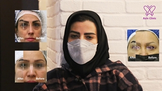 تجربه کاشت ابرو