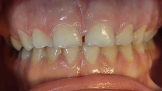 اصلاح لبخند لثه ای