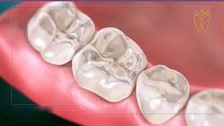 سایش دندان ها