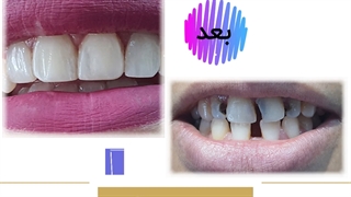کامپوزیت ونیر مشهد پاکسازی پوست