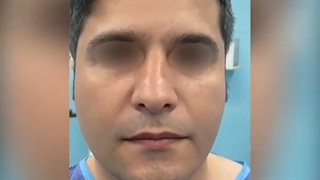 جراحی بینی با انحراف شدید