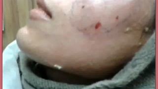 عوارض احتمالی تزریق ژل در نواحی مختلف صورت و بدن ترمیم لبخند لثه‌ای