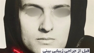 نمونه کار جراحی بینی دکتر احمد دانشی