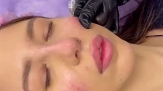 تزریق ژل گونه سیتوسیال