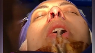 فیلم عمل زیبایی بینی