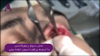 فیلم عمل سپتورینوپلاستی