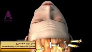 فیلم عمل لیفت اندوسکوپیک پیشانی