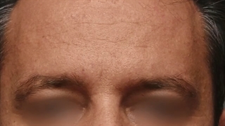 لیفت آندوسکوپی پیشانی