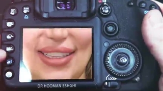 لبخندی هالیوودی را با ما تجربه کنید