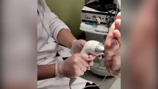 درمان زخم پای دیابتی با لیزر و پودر امینیون