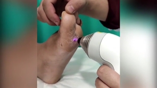 درمان زخم پای دیابتی با لیزر