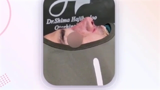 انجام عمل بینی مردانه توسط یکی از بهترین جراحان زیبایی تهران