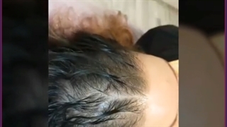 دلایل ریزش موی جلوی سر و راهکارهای درمان آن