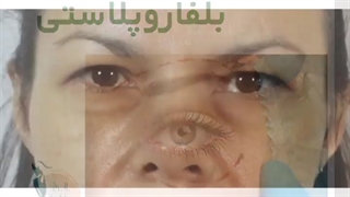 جراحی بلفاروپلاست