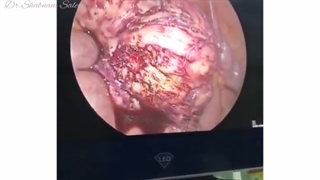 درمان فیبروم رحم