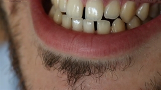 بستن فواصل بین دندانها با کامپوزیت هم رنگ دندان مراجعه کننده