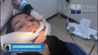 جا گذاری نگه دارنده در دندان | دکتر نگار حدادی برداشتن توده