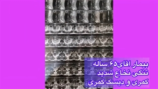 بیمار آقای 65 ساله با تنگی نخاع کمری و دیسک شدید