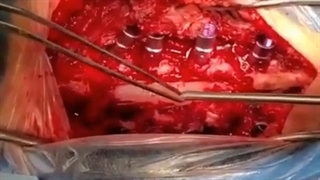 خانم 52 ساله با تنگی شدید کانال کمری و دیسک کمری