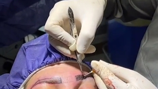 فیلم بدون سانسور کاشت ابرو از نزدیک