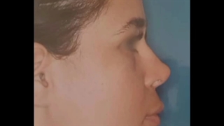 تخلیه چربی بوکال یا بوکال فت
