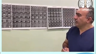 عمل جراحی شوانوم وستیبولار تومور سی پی انگل (CPA)