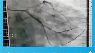 انسداد کامل یکی از عروق کرونر و تنگی شدید دو رگ دیگر