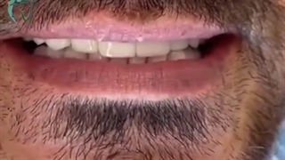 کامپوزیت دندان