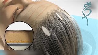 لیفت اندوسکوپی ابرو در مقابل روش باز