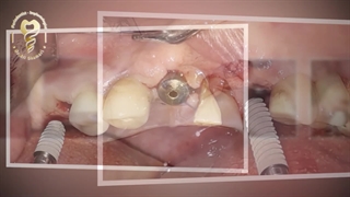 کاشت سه واحد ایمپلنت بدون جراحی و بخیه