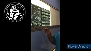 درصورت ناموفق بودن ای آرسی پی در خارج کردن سنگهای مجرای صفرا