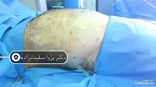 نتیجه لیپوماتیک شکم