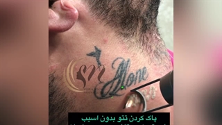 پاک کردن تتو ( کلینیک زیبایی استار بیوتی )