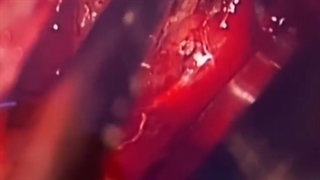 جراحی تومور سی پی انگل