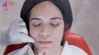 رووفیل پلاس برای لب و خط خنده