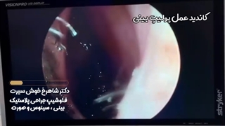 عمل زیبایی بینی و پولیپ آیا با هم انجام می شود یا خیر؟ | دکتر شاهرخ خوش سیرت