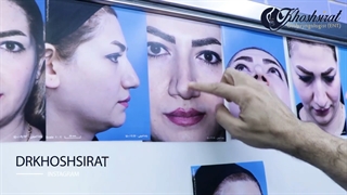 جراحی زیبایی بینی (بخش دوم) | دکتر شاهرخ خوش سیرت