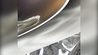 شکستگی پلاتو تیبیا