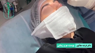 لیفت بینی با نخ | دکتر فرشته جلالپور