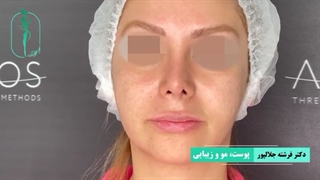 لیفت گونه با نخ و درمان اسکار اکنه با ساب سیژن و تزریق چربی | دکتر فرشته جلالپور